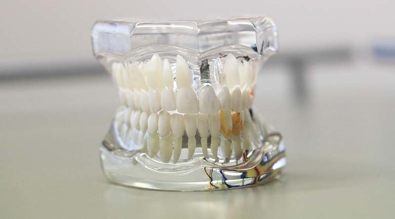 Knochenaufbau für Zahnimplantate
