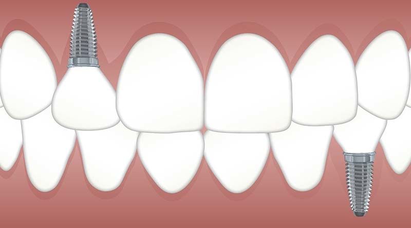 Implantate für Zahnlücken