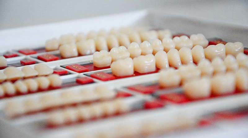 Voraussetzungen für Zahnimplantate